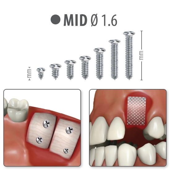 Picture of MID Ø 1.6 - Titanium Screws