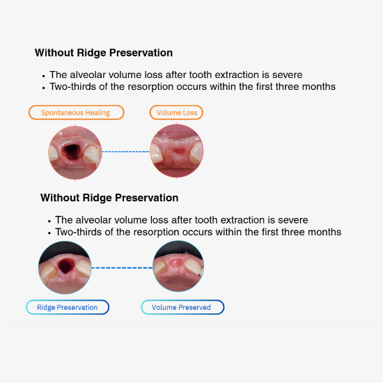 Picture of Ridge Preservation