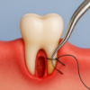 Picture of Periodontal Treatment