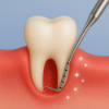 Picture of Periodontal Treatment