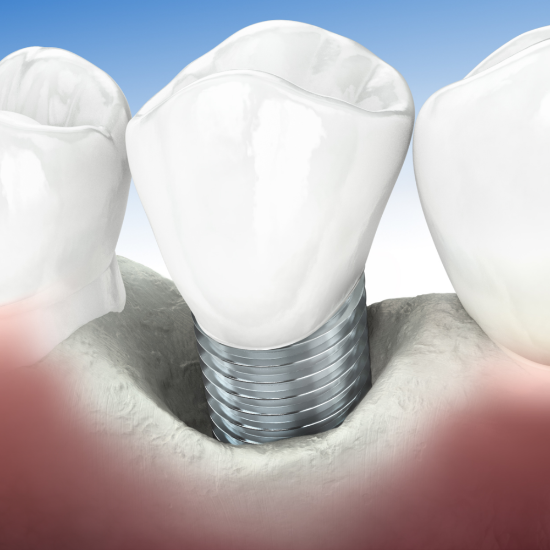 Picture of Peri-implantitis Treatment