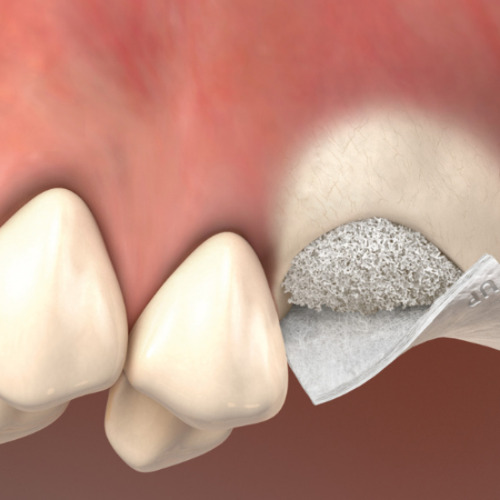 Picture of Sinus Floor Elevation Treatment