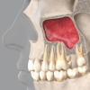 Picture of Sinus Floor Elevation Treatment