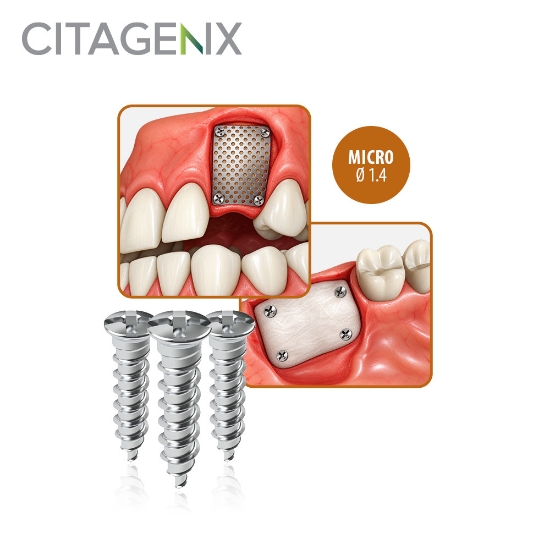 Picture of MICRO Ø1.4 - Titanium Screws