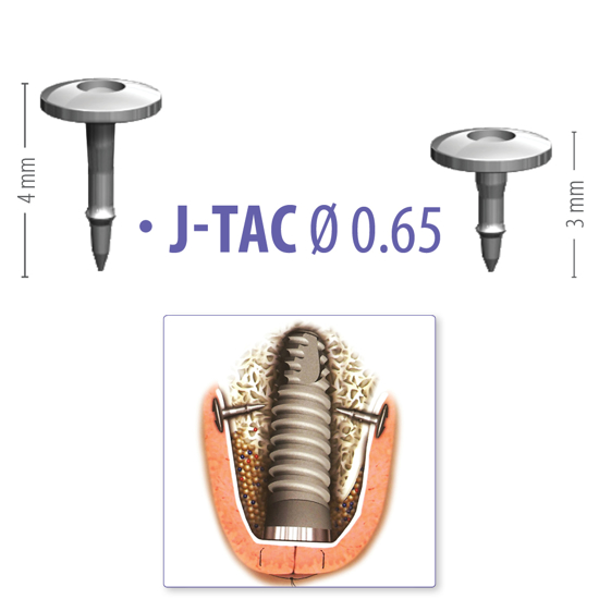 Picture of J-TAC Ø 0.65 - Titanium Tacks