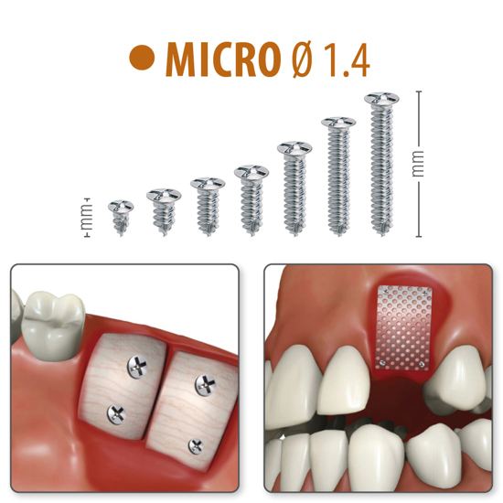 Picture of MICRO Ø1.4 - Titanium Screws